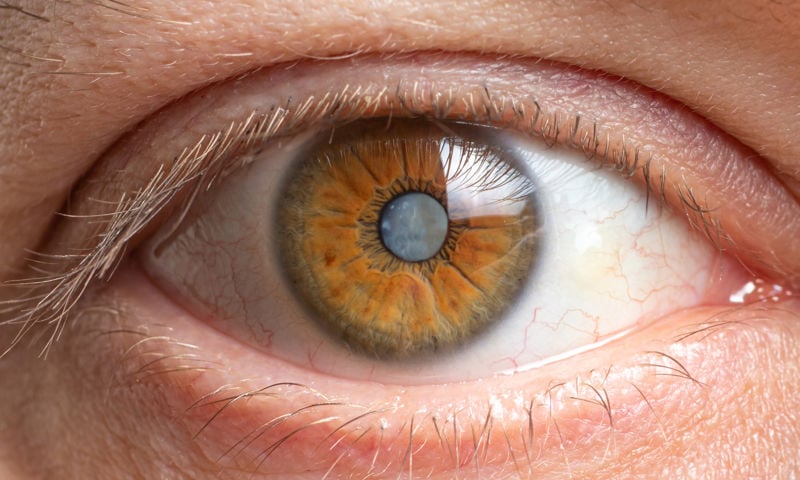 Eye with cataracts